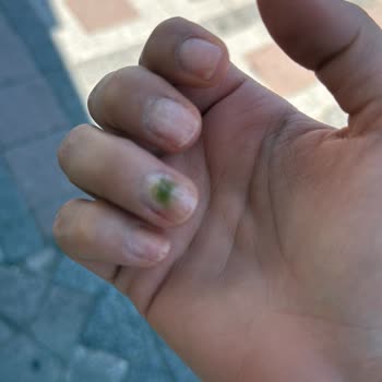 Çiğdem Köroğlu Beauty Tırnak Bakımı Sonrası Enfeksiyon Ve İlgisizlik