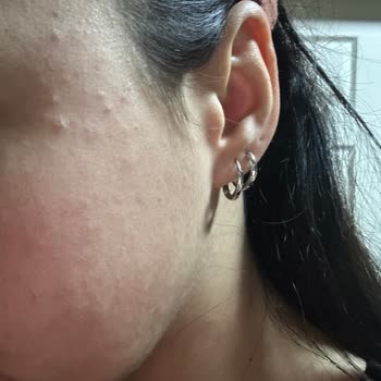 Nivea Gesichtsschaum löste nach 2 Tagen starke Pickel und Brennen aus