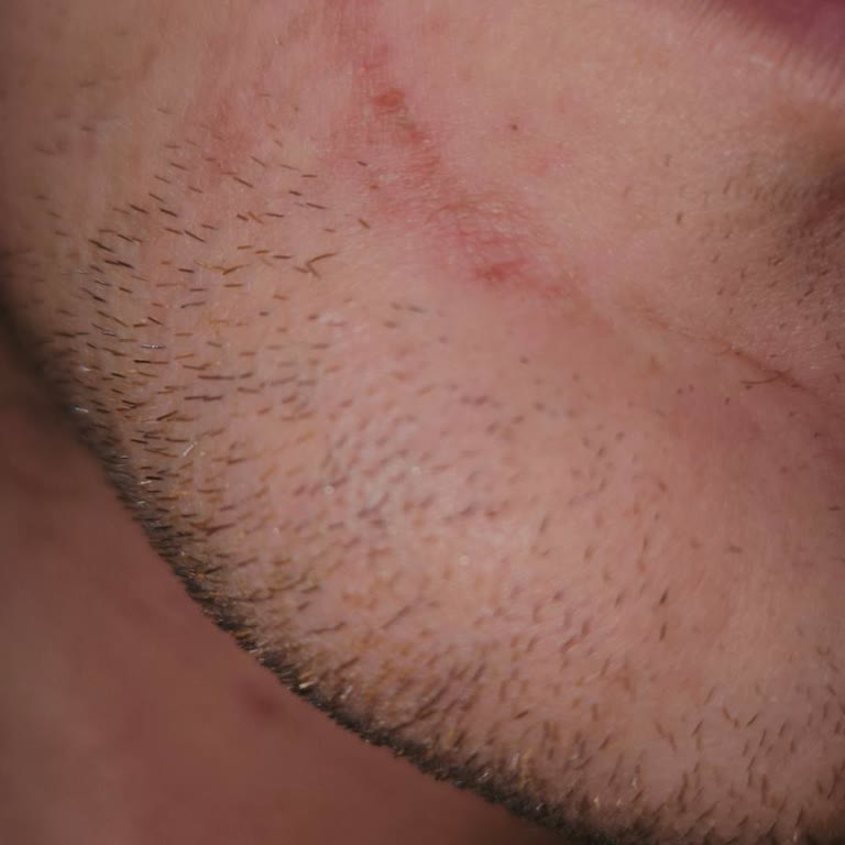 La Roche-Posay Reinigungs-Gel und Duo+ Creme verursachen Hautverbrennungen und Abschälungen