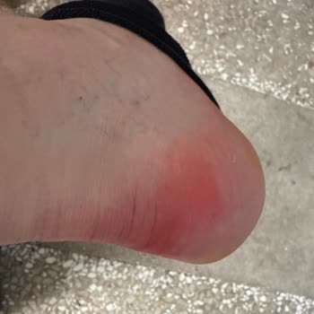 Aldığım Ayakkabılar Ayağımı Boyadı, Müşteri Hizmetleri İlgisiz Kaldı