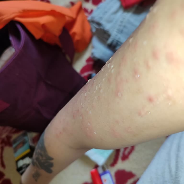 Avon Parfümü Alerji Yaptı, Sağlığım Bozuldu