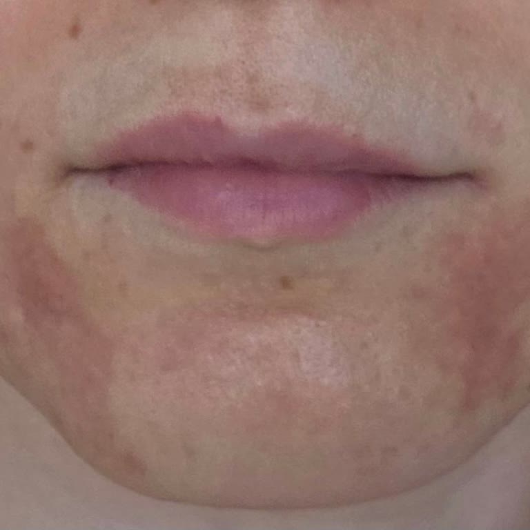 Yanlış Uygulama Ve Uzayan Yan Etkiler Nedeniyle Memnuniyetsizlik