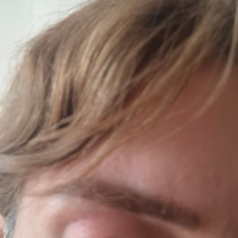 I Used L’Oréal Revitalift Laser Serum and It Caused Severe Eczema on My Face