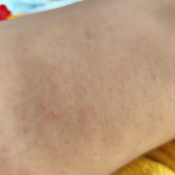 I Used Mustela Baby Shampoo and It Caused Severe Allergic Reactions Twice on My Infant
