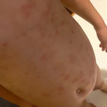 Alerji Yapan Krem Nedeniyle Mağduriyet Ve Acil Çözüm Talebi