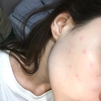 I Reused Sinoz Green Face Wash and It Suddenly Caused Strange Spots on My Skin