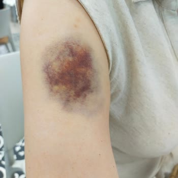 Yanlış Montaj Sonucu Termosifon Kazası: Hem Eşyalarım Hem Sağlığımız Zarar Gördü!