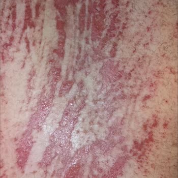 Tüy Dökücü Krem Ciddi Cilt Yanığına Sebep Oldu