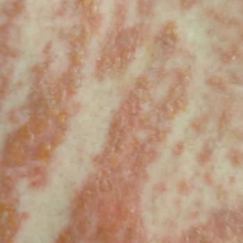 Tüy Dökücü Krem Ciddi Cilt Yanığına Sebep Oldu