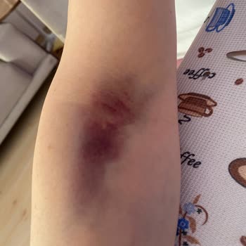 Erdem Hastanesi Check-up Sonrası Oluşan Morarma İçin Hastaneden Sorumluluk Bekliyoruz