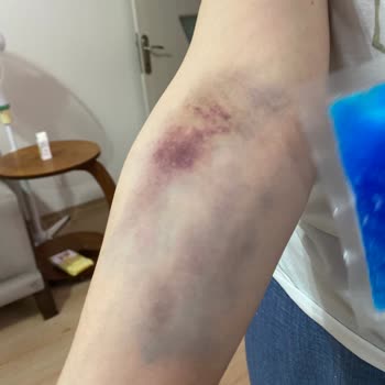 Erdem Hastanesi Check-up Sonrası Oluşan Morarma İçin Hastaneden Sorumluluk Bekliyoruz