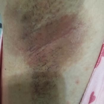 Rexona Stick Deodorant Kol Altımda Ciddi Tahrişe Sebep Oldu!