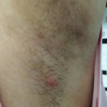 Rexona Stick Deodorant Kol Altımda Ciddi Tahrişe Sebep Oldu!