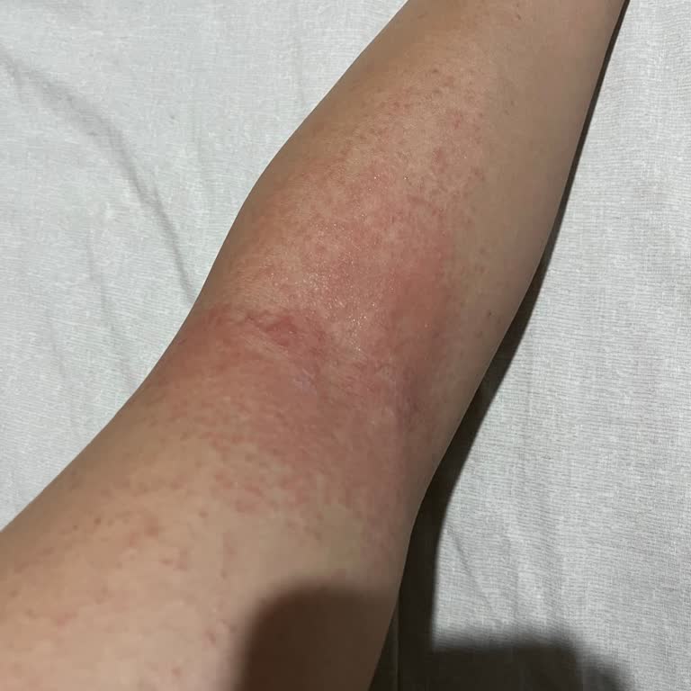 Hassas Ciltlere Uygun Tüy Dökücü Kollarımı Yaktı