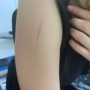 Korkmaz Mutfak Eşyaları Emniyetli Olduğu Söylenen Düdüklü Tencere Patladı, Yaralandım