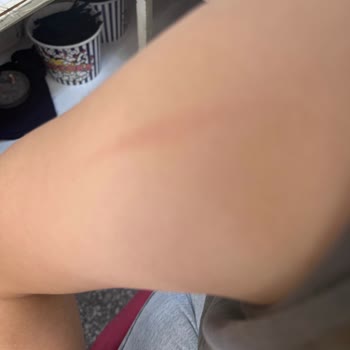 Korkmaz Mutfak Eşyaları Emniyetli Olduğu Söylenen Düdüklü Tencere Patladı, Yaralandım