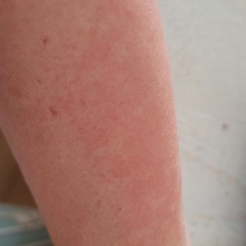 Incia Sinek Kovucu Sprey Cildimde Alerji Ve Kaşıntı Yaptı, İade Talebim Reddedildi!