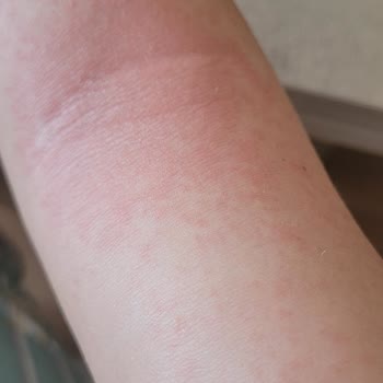 Incia Sinek Kovucu Sprey Cildimde Alerji Ve Kaşıntı Yaptı, İade Talebim Reddedildi!