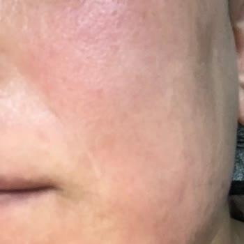 Sinoz Pigmentfleckencreme & Serum zerstören meine Haut, starke Reizung nach nur 2 Tagen Anwendung