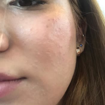 Sinoz Perfect Serum Cleansing verursacht Hautverbrennung