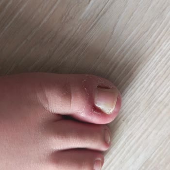 Inday Klinik Başarısız Operasyon Ve Yetersiz Klinik Hizmeti Sonrası Mağduriyet