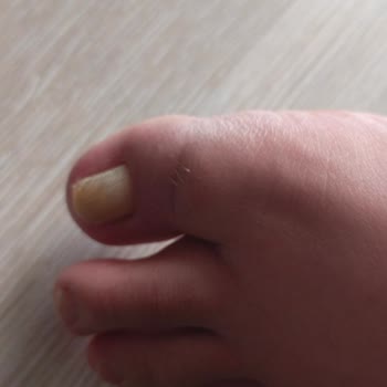 Inday Klinik Başarısız Operasyon Ve Yetersiz Klinik Hizmeti Sonrası Mağduriyet