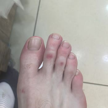 Kullanım Sonrası Sorunlu Krampon İçin Değişim Ve İade Talebim Reddedildi