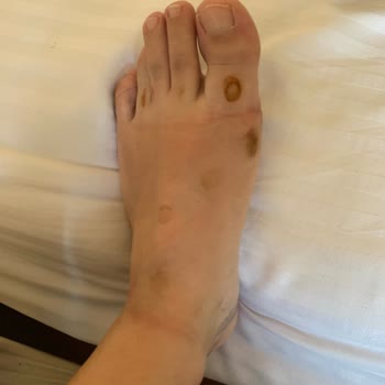 Elle Mağazasından Alınan Sandaletin Metal Aksamı Ayakta Pas İzi Bıraktı, Ücret İadesi Talebim Reddedildi