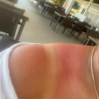 Mustela Sun Cream Didn’t Protect Me—Suffered Painful Sunburn Despite Proper Use