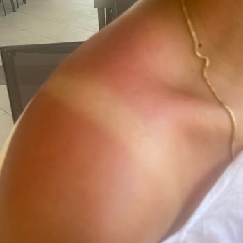 Mustela Sun Cream Didn’t Protect Me—Suffered Painful Sunburn Despite Proper Use