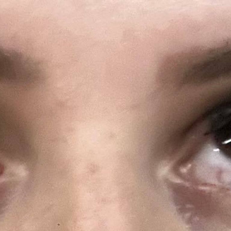 Güzellik Hizmeti Sonrası Göz Sağlığı Problemi ve Yetersiz Destek Şikayeti