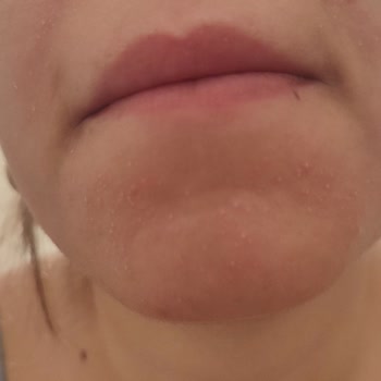 I Face Severe Skin Damage After Using Sinoz Face Wash Just a Few Times