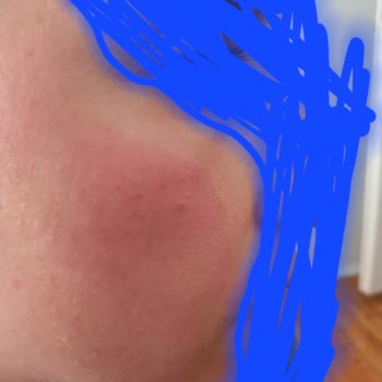 Eyüp Sabri Tuncer Gül Suyu Kolonyası Ciltte Ciddi Kızarıklık Ve Yanık Yaptı