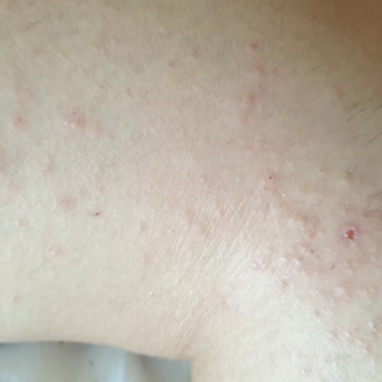 Yves Rocher Işıltılı Vücut Yağı Alerjiye Sebep Oldu, Tatilimiz İptal Oldu