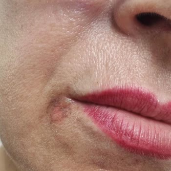 Epilasyon Ve Botox Sonrası Mağduriyetim Giderilmiyor