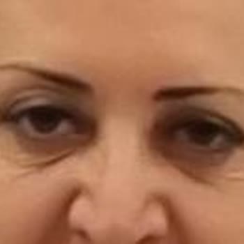 Epilasyon Ve Botox Sonrası Mağduriyetim Giderilmiyor