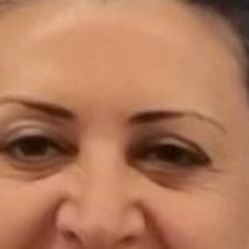 Epilasyon Ve Botox Sonrası Mağduriyetim Giderilmiyor