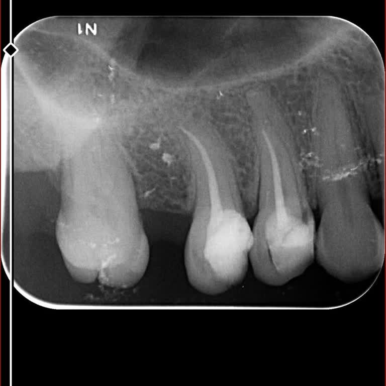 Yanlış Kanal Tedavisi Sonrası Dayanılmaz Diş Ağrısı