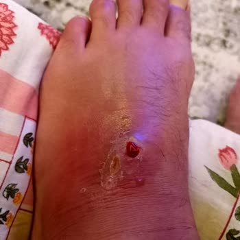 Aldığım Sandalet Ayağımda Ciddi Yaralara Sebep Oldu