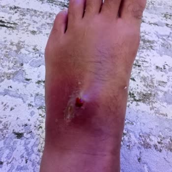 Aldığım Sandalet Ayağımda Ciddi Yaralara Sebep Oldu