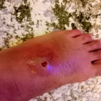 Aldığım Sandalet Ayağımda Ciddi Yaralara Sebep Oldu