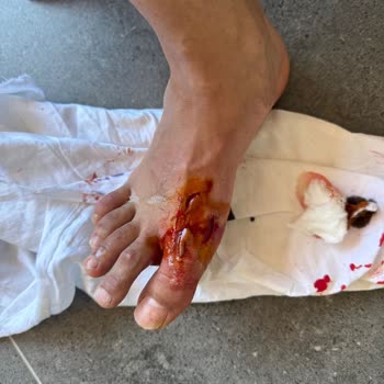 Havuzdaki Kablo Nedeniyle Ayağım Kesildi, Otel Yönetimi İlgisiz Kaldı