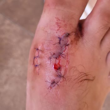 Havuzdaki Kablo Nedeniyle Ayağım Kesildi, Otel Yönetimi İlgisiz Kaldı