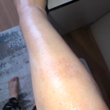 Trendyol Aldığım Ürün Hem Hasarlı Geldi Hem De Yanık Yaptı!