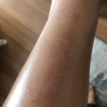 Trendyol Aldığım Ürün Hem Hasarlı Geldi Hem De Yanık Yaptı!