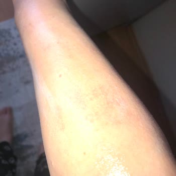 Aldığım Philips Lumea Hem Hasarlı Geldi Hem De Cildimde Yanık Yaptı