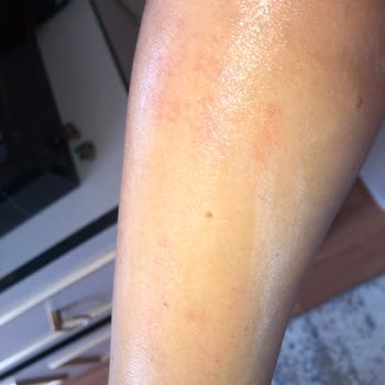 Aldığım Philips Lumea Hem Hasarlı Geldi Hem De Cildimde Yanık Yaptı