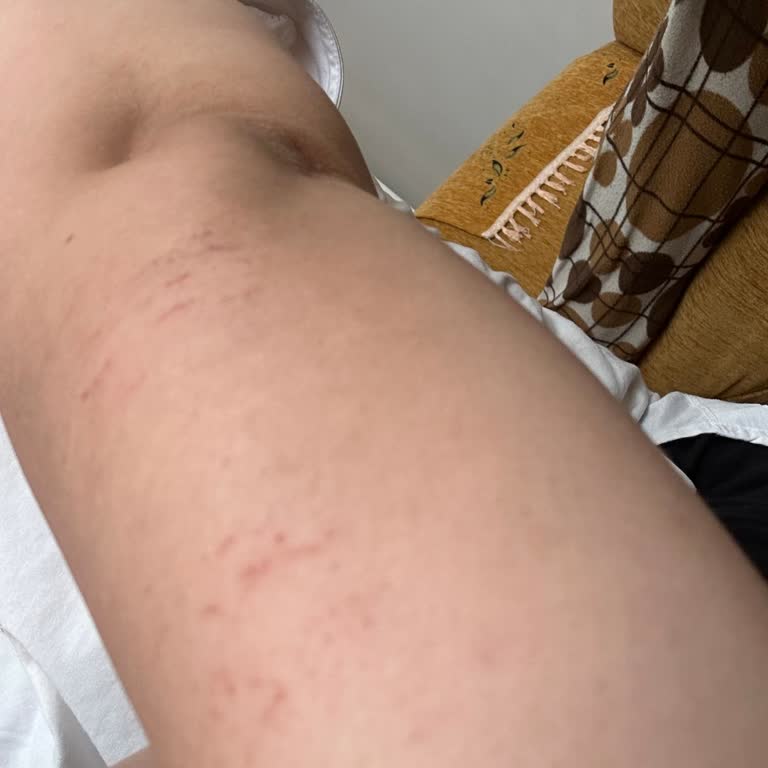 Lazer Epilasyon Sonrası Yanık Ve Hijyen Sorunu