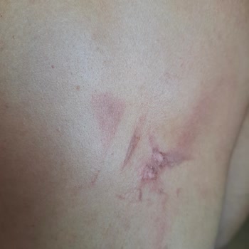 Yolculuk Sırasında Sıcak Su Kazası Ve İlgisizlik Nedeniyle Mağduriyet