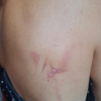 Yolculuk Sırasında Sıcak Su Kazası Ve İlgisizlik Nedeniyle Mağduriyet